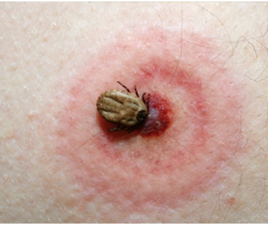 Lyme-kór ellen a 4 legkiválóbb gyógynövény