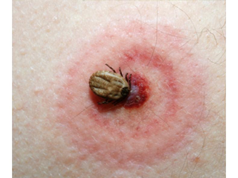 Lyme-kór ellen a 4 legkiválóbb gyógynövény
